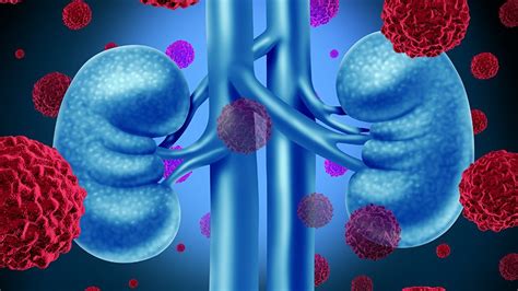 Os Primeiros Sintomas Do C Ncer De Rim Dicas De Sa De