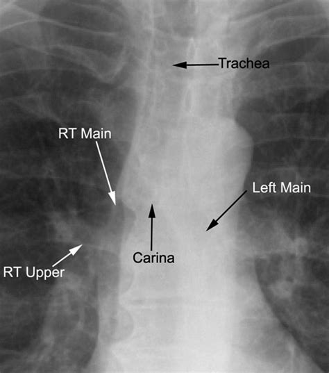 Carina Lung Xray