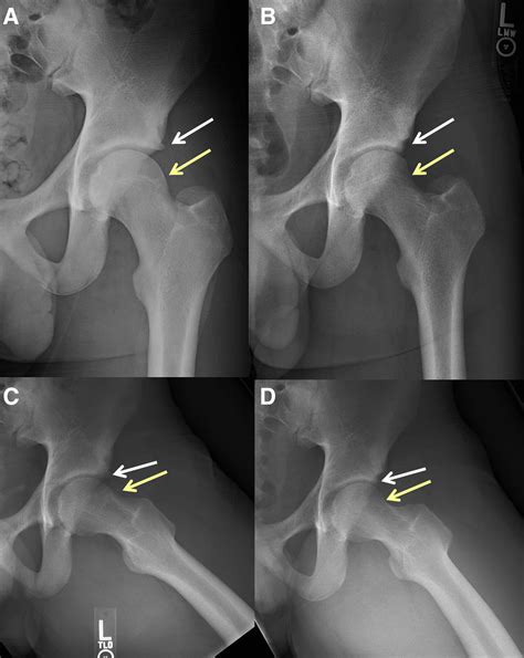 Hip Arthroscopy For Removal Of An Acetabular Rimbased Osteoid Osteoma