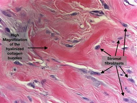 Histology Of Keloid Keloidal Scar An Abnormal Raised Reactive