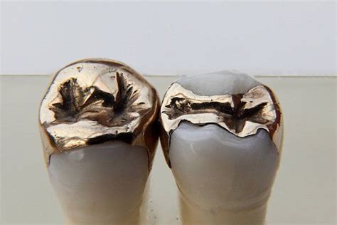 Four Alternatives to Tooth Caps | Teeth caps, Teeth, Dental crowns