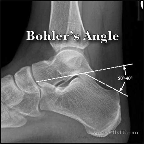 Calcaneus Anatomy | eORIF