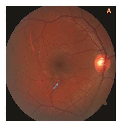 First Month Of Examination Of The Patient A All Hemorrhages Were