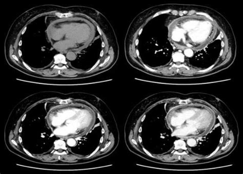 CT images revealed pericardium thickening and enhancement with a ...