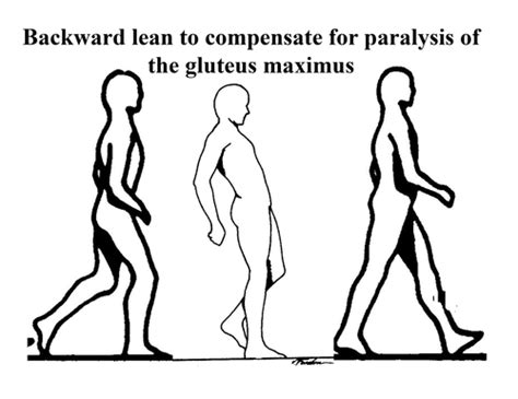 Normal Gait And Compensatory Gait Flashcards Quizlet