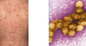 West Nile Virus Rash | Symptoms | Diagnosis | Best Treatment