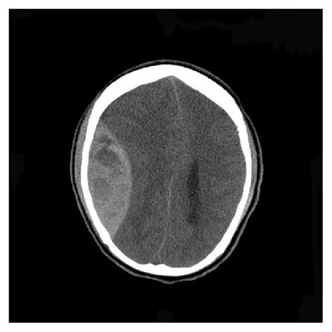 Imagenología De La Cabeza Y El Cerebro Concise Medical Knowledge