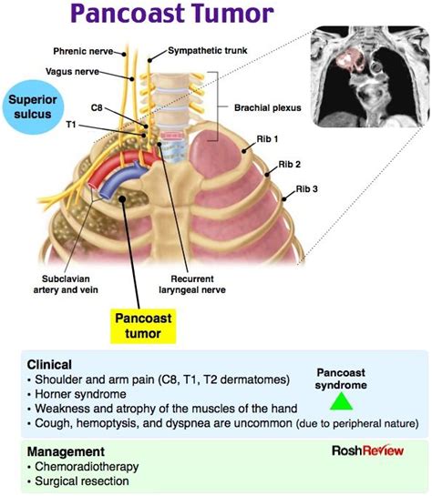 Pancoast Tumor | Medical knowledge, Medical radiography, Medical ...