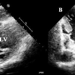 Transthoracic Echocardiogram In Subcostal View A And Two Chamber View