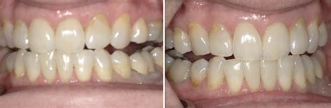 Posterior Open Bites Case Study Ignitedds