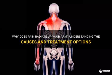 Why Does Pain Radiate Up Your Arm Understanding The Causes And