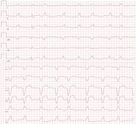 Literature Review: modified Sgarbossa criteria in the diagnosis of ...