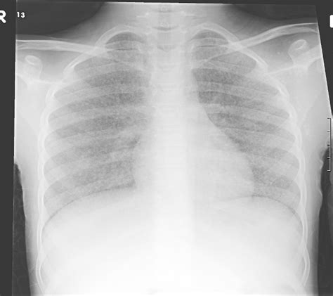 Tb Chest X Ray : Chest X Ray Showing Normal Chest And Pulmonary ...