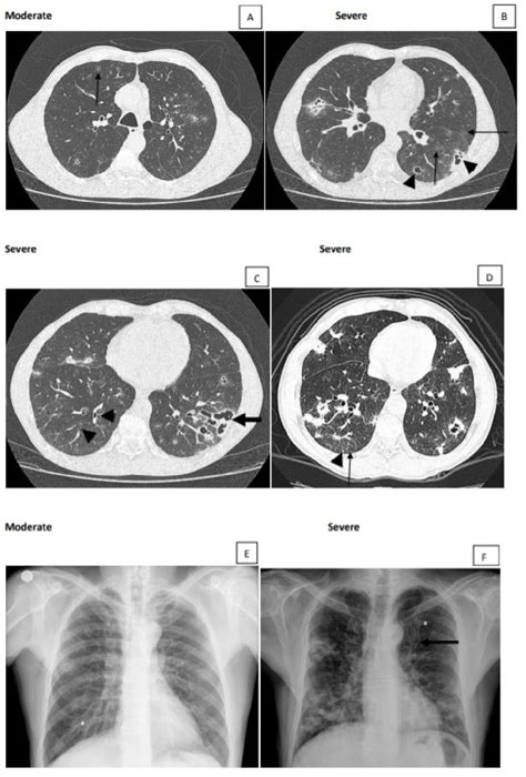 Moderate and severe active lesions. (A) Moderate lesion showing > 3 ...