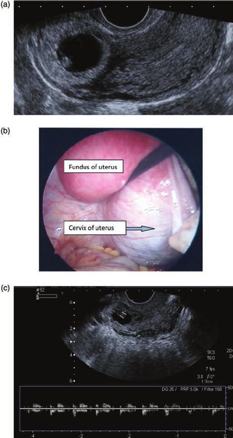 A Cervical Pregnancy B Laparoscopic View Of Cervical Ectopic