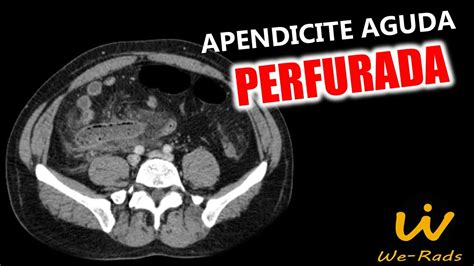 Apendicite Aguda Perfurada Aeroportia Na Tomografia Youtube