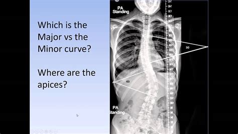 Scoliosis How To Medically Classify Scoliosis The Lenke System For