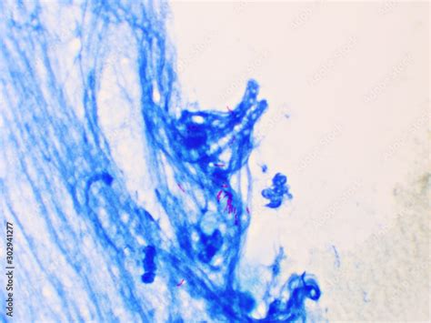 Mycobacterium Tuberculosis Positive Small Red Rod In Sputum Smear Acid Fast Stain Analyze By