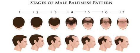 The First Signs Of Baldness What To Look For Justinboey