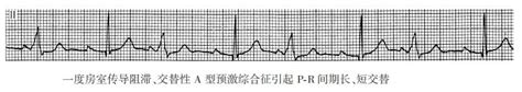 【附图】 Pr间期长、短交替 心电图学 天山医学院