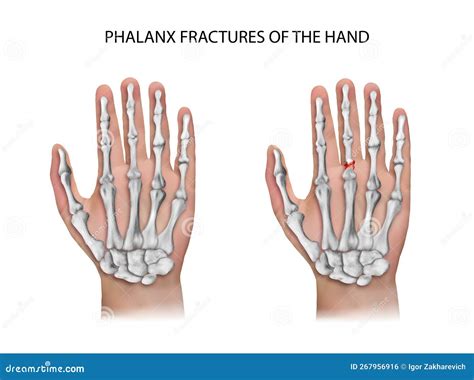 Phalanx Fractures Of The Hand Stock Illustration Illustration Of