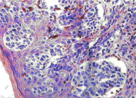 Histopathology Of Scrotal Lesions Tumor Cells With Bright Cytoplasm