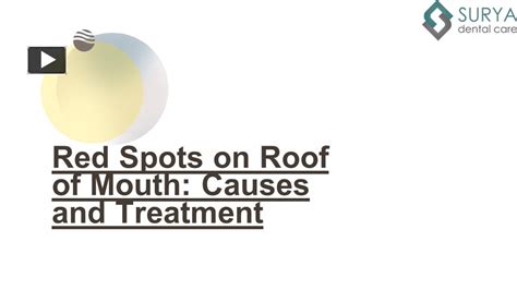 Ppt Red Spots On Roof Of Mouth Causes And Treatment Powerpoint