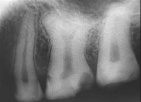 Taurodontism: Types, Causes & Treatment | Longevita