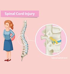 Diagram showing spinal cord injury Royalty Free Vector Image