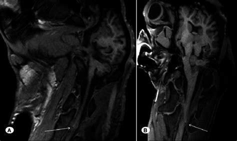 Magnetic Resonance Imaging reveals the lesion at the spinothalamic... | Download Scientific Diagram