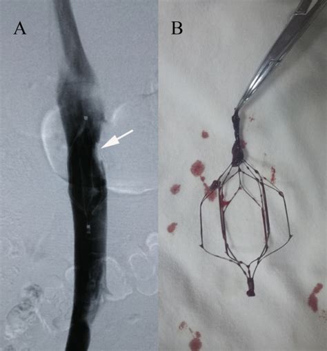 Retrievable Inferior Vena Cava Filters In Trauma Patients Prevalence