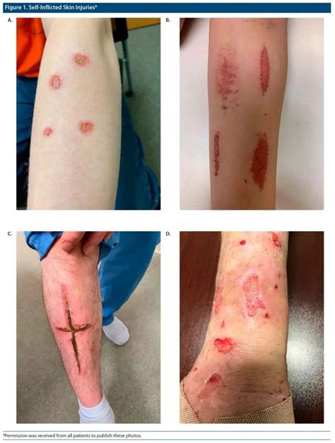 A Brief Review Of Dermatitis Artefacta And Management Strategies For