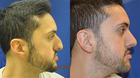 Nose Surgery Before & After Photos Patient 146 | San Francisco, CA ...