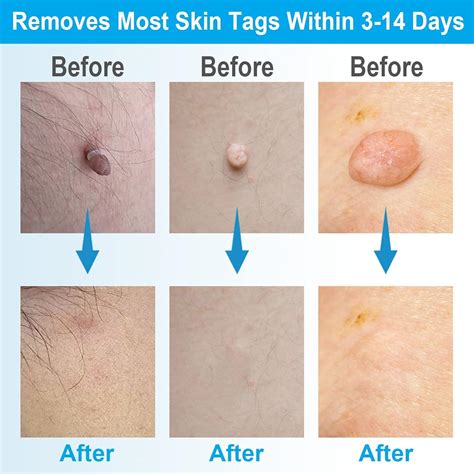 painless    skin tag removal kit  micro  large skin tags