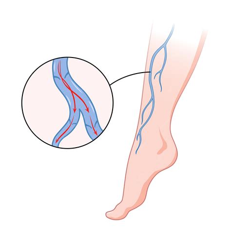 Veia Importante Da Perna - Veias varicosas vaso sanguíneo azul visível através da pele perna ...