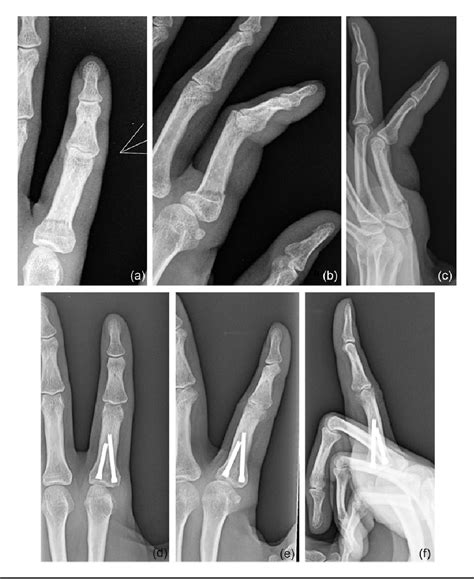 Figure From Dual Antegrade Intramedullary Headless Screw Fixation For