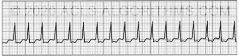 Ekg Practice Test 1 Learn And Master Acls Pals