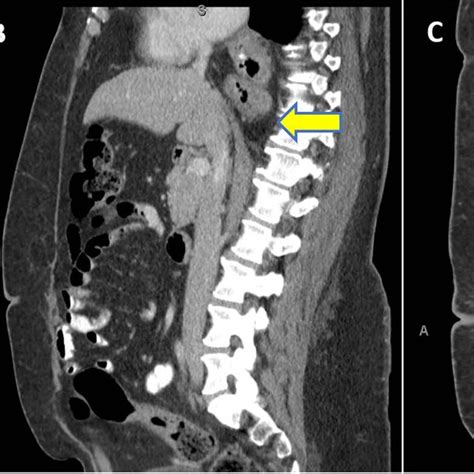 A Laparoscopic View Posterior Hiatal Hernia Repair 1 Distal