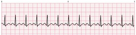sinus tachycardia training video procpr