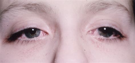 Ataxia-Telangiectasia | Hereditary Ocular Diseases