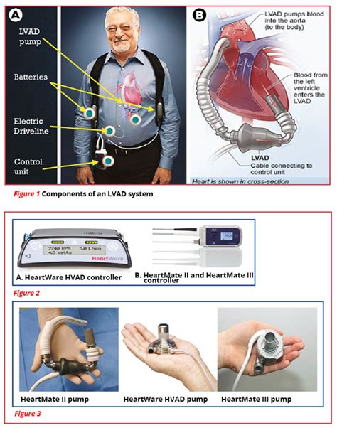 Left Ventricular Assist Device Lvad A Guide For Healthcare Workers