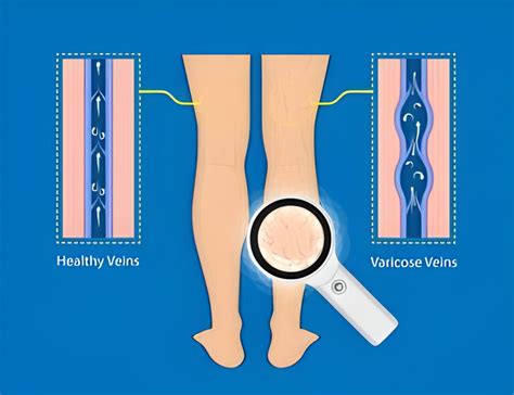 Endovenous Foam Treatment Evft For Varicose Veins A Minimally Invasive Solution