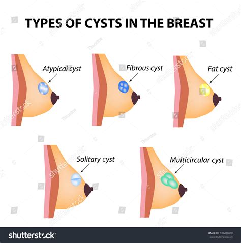 Types Cysts Breast Atypical Fibrous Fatty Stockillustration 730204870 Shutterstock