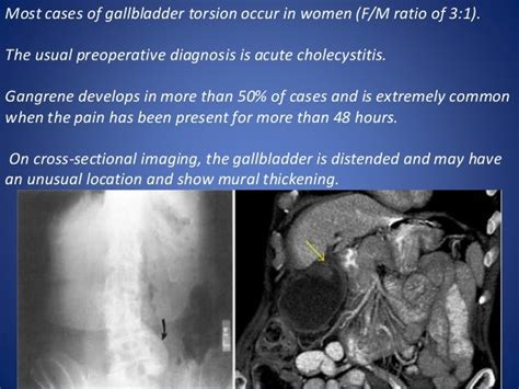 Gall Bladder And Biliary Tract Anomalies And Variants