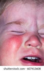 Red Skin Spots Allergic Reaction Childs Stock Photo 607413608 ...