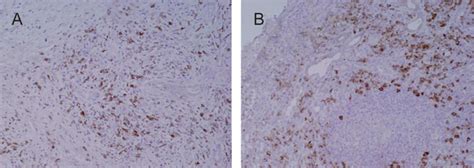 The Specimens Of Minor Salivary Glands A C Mikuliczs Disease B D