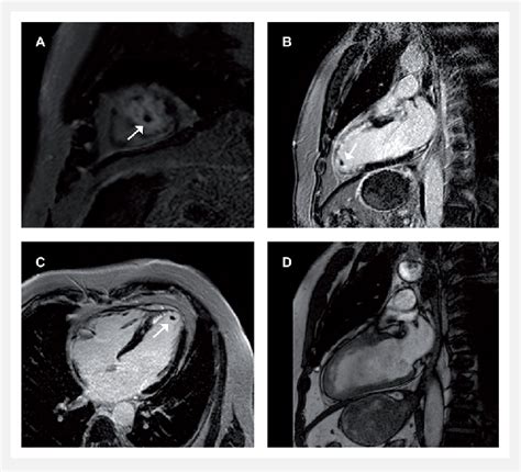 Left Ventricular Thrombus 0 166 Cm 3 Shown In The Short Axis A Download Scientific