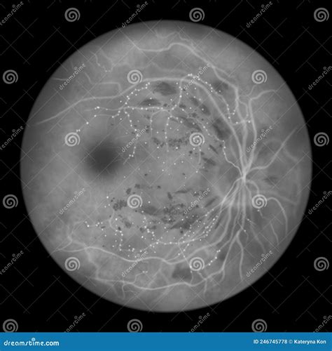 Ilustración De Diagnóstico De Retinopatía Diabética Oftalmoscópica