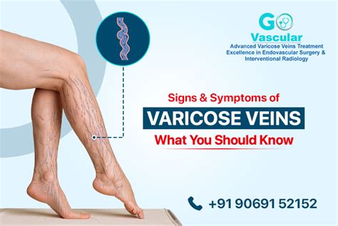 Signs And Symptoms Of Varicose Veins What You Should Know Go Vascular