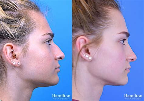 closed rhinoplasty procedure    elaruq